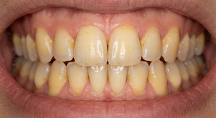 yellow, stained teeth