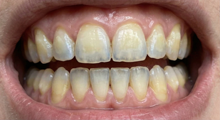 weak, sensitive enamel